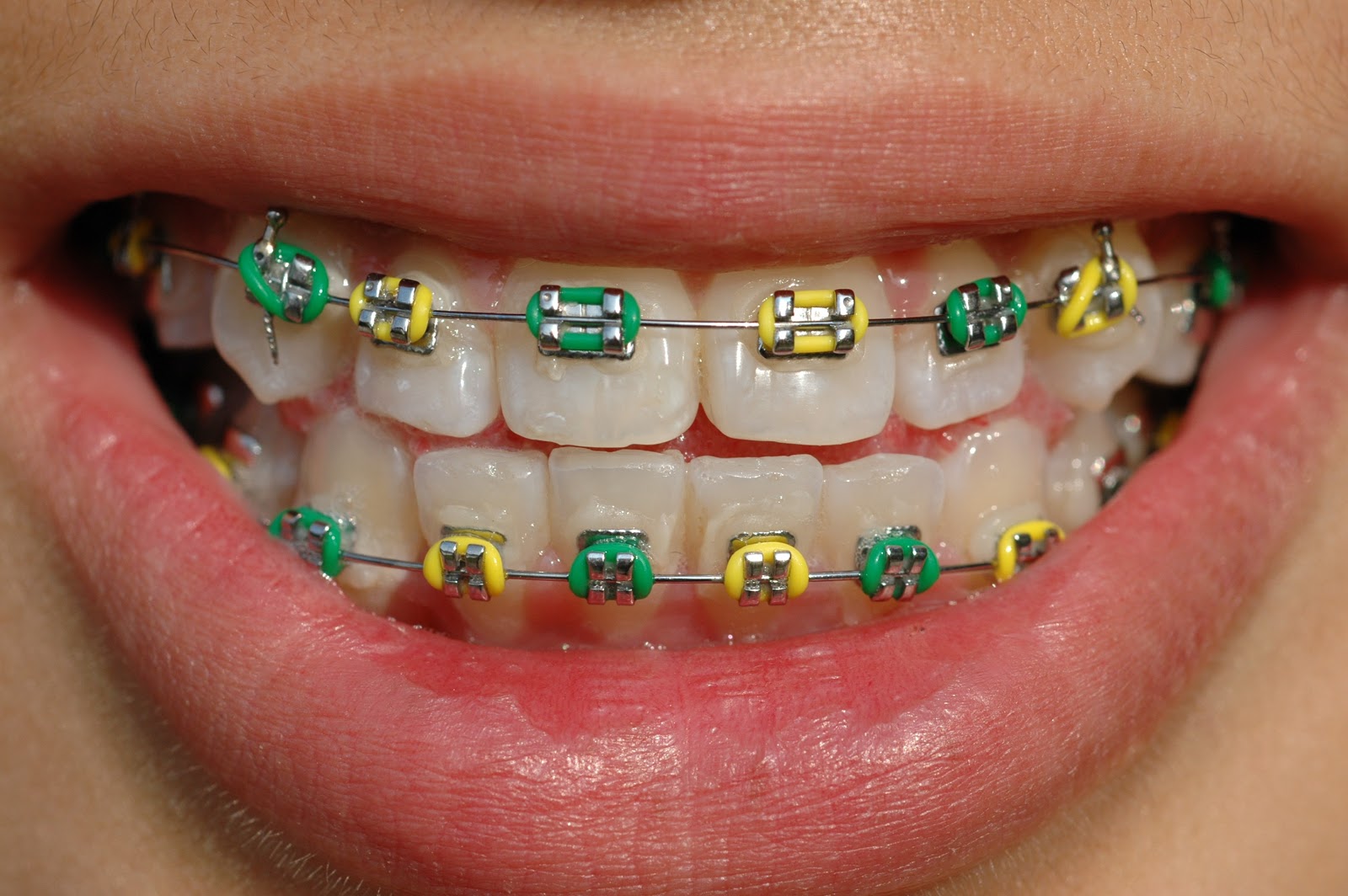 Orthodontist Vs. Dentist Braces