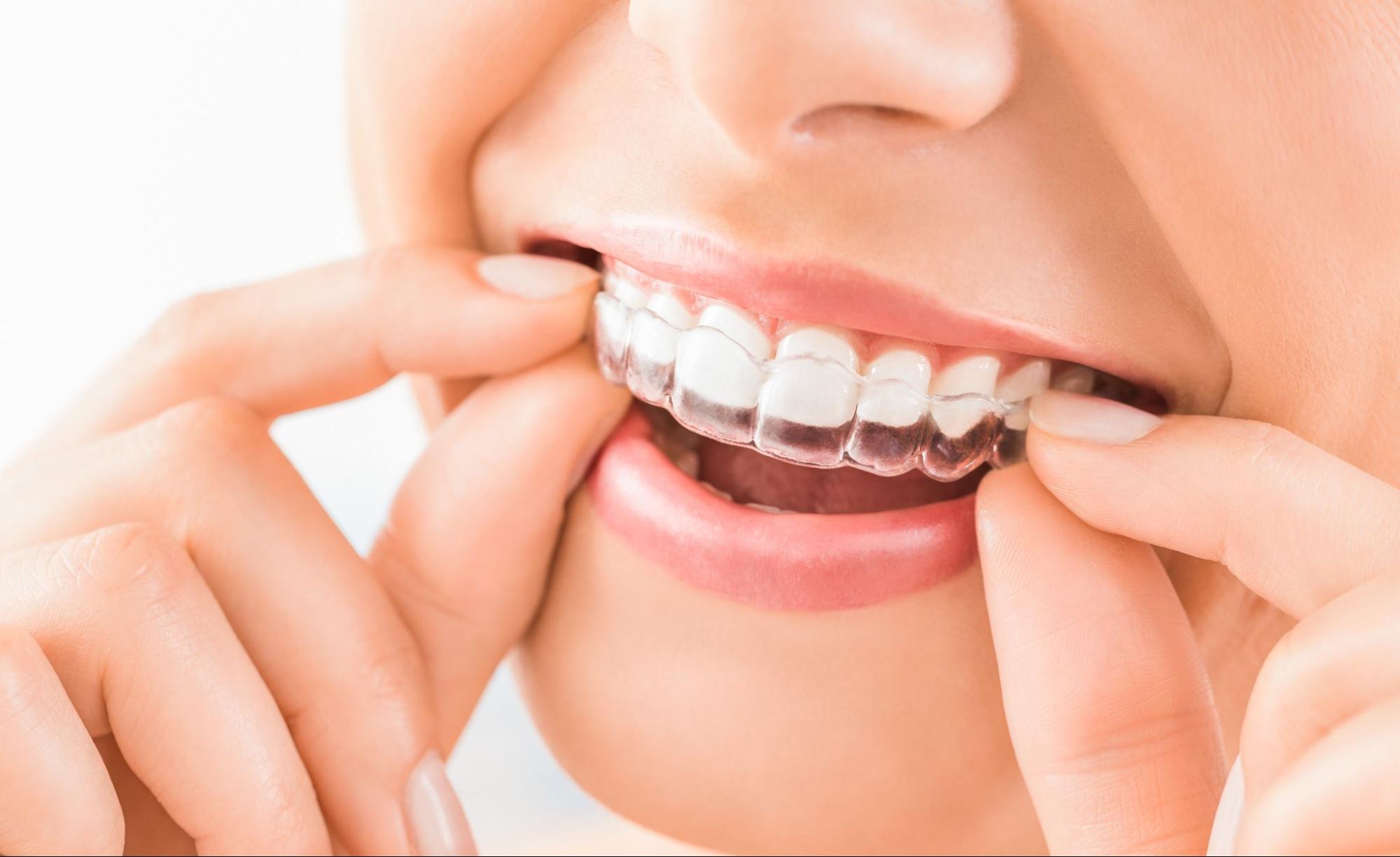 How to Get the Most Out Of Your Invisalign